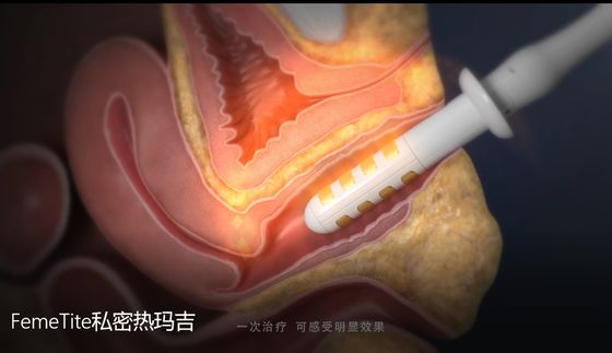 Tress Urinary RF Vaginal Rejuvenation Therapy Incontinence Vaginal Clinical Studies