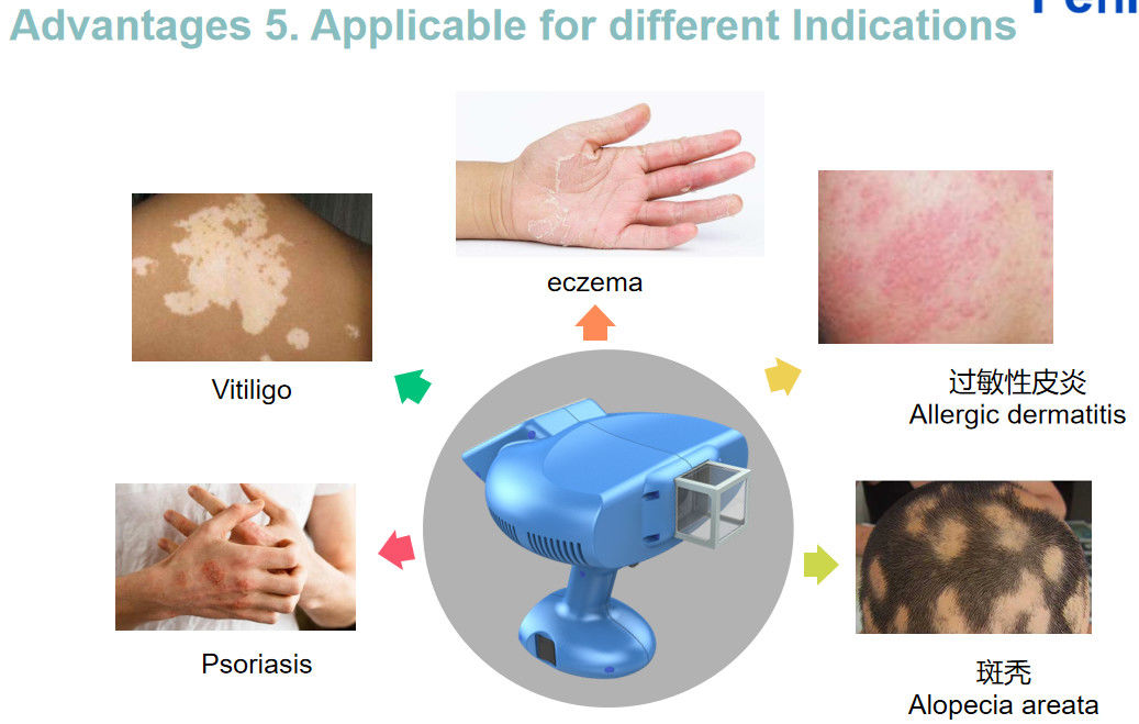 Treat Vitiligo 308NM Excimer Psoriasis Laser Machine Blue Light Color
